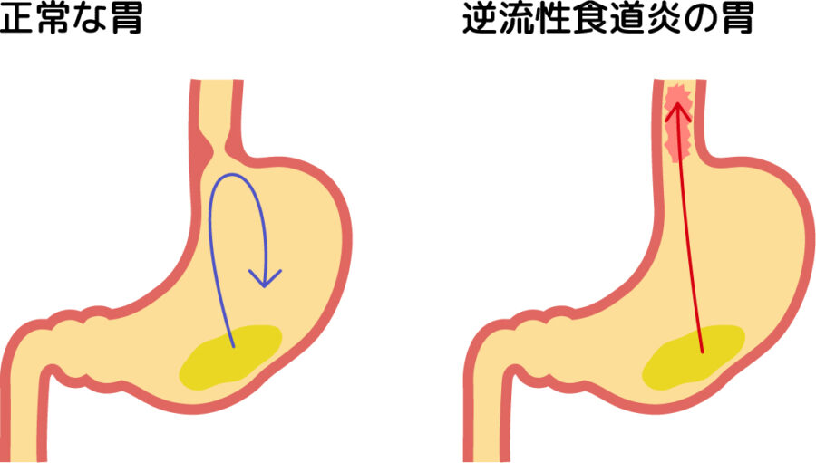 逆流性食道炎の仕組み